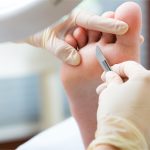 Quiropodología Barcelona - Elimina durezas y callos de los pies