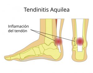 Tendinitis aquilea, inflamación tendón de aquiles