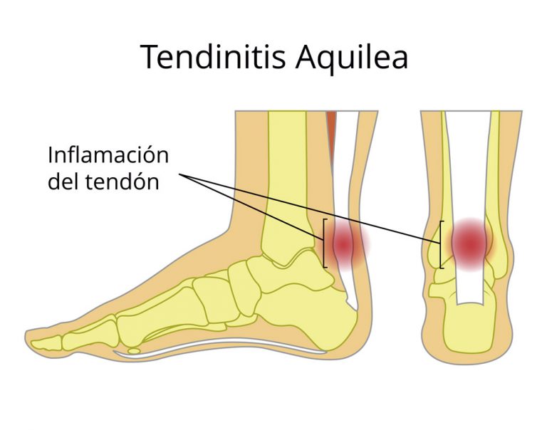 Tendinitis aquilea, inflamación tendón de aquiles