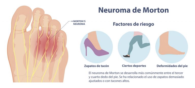 Neuroma de morton