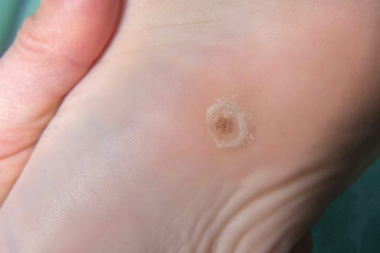Verruga plantar