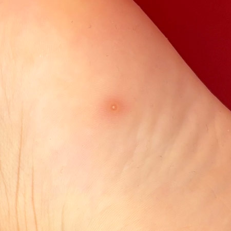Verruga plantar incipiente