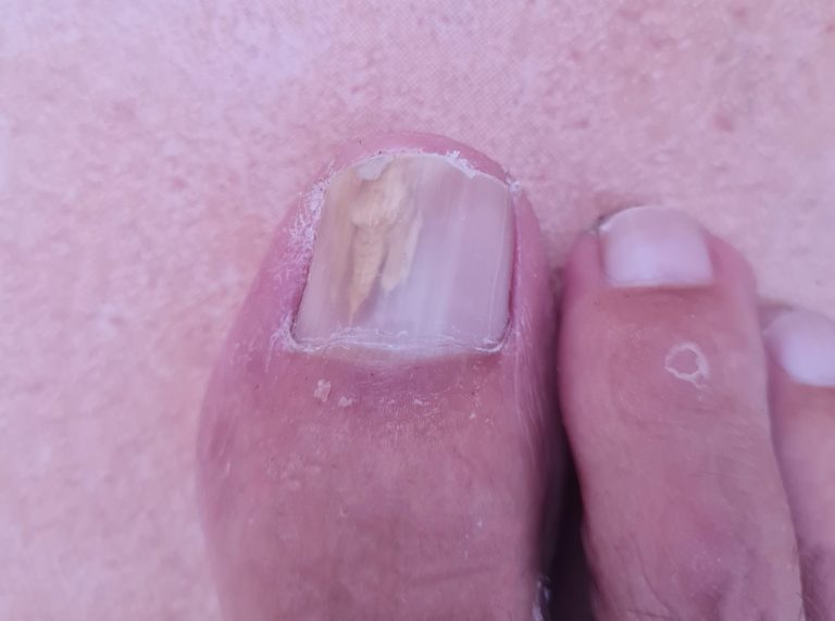 Hongos en las uñas del pie