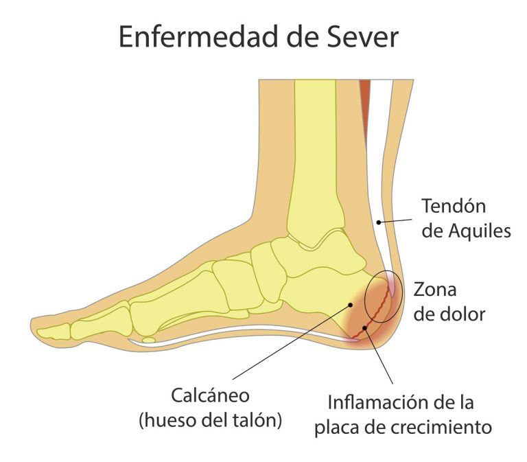 Enfermedad de Sever, dolor en talón en etapa de crecimiento