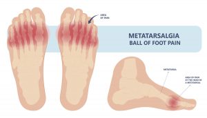 Metatarsalgia, dolor en los dedos del pie