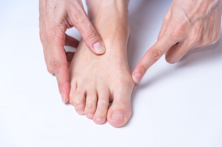 Juanetes pies, Hallux Valgus