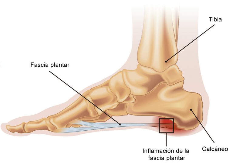 Menopausia y Fascitis Plantar