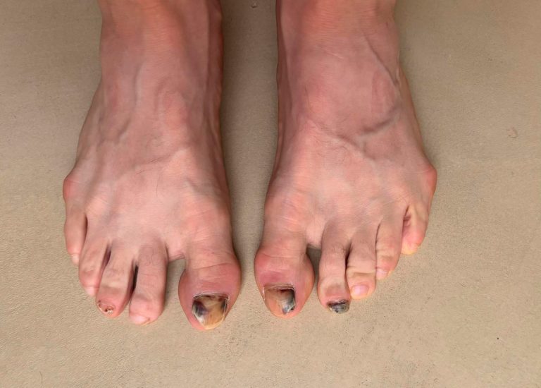 Lesiones pies de runner