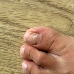 Manchas blancas en las uñas del pie