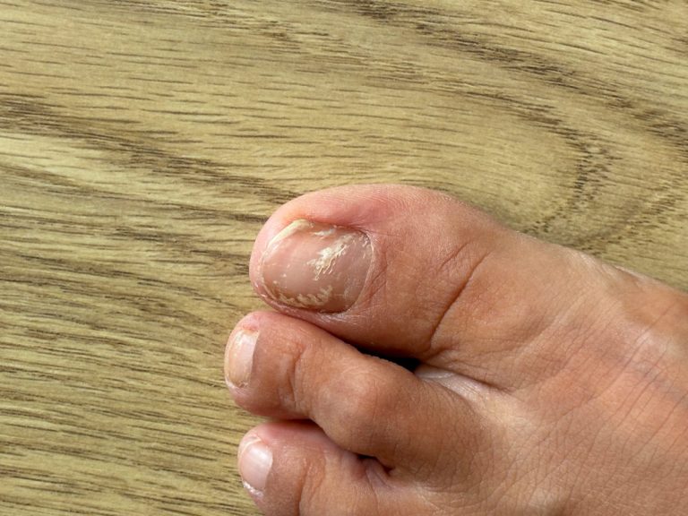 Manchas blancas en las uñas del pie