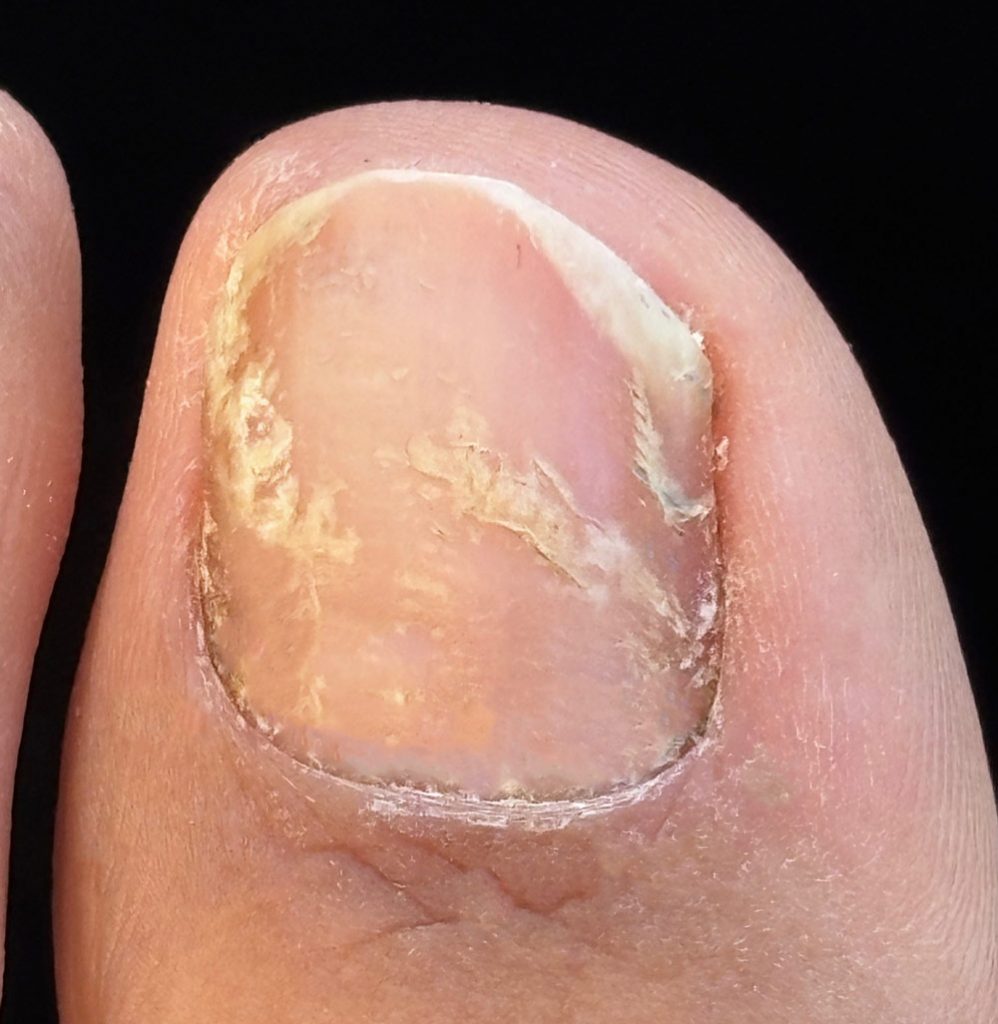 Manchas blancas en las uñas del pie