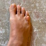 Dedo meñique del pie montado