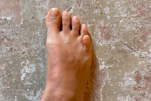 Dedo meñique del pie montado