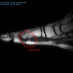 Sesamoiditis resonancia magnetica