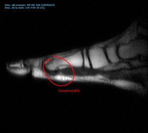 Sesamoiditis resonancia magnetica
