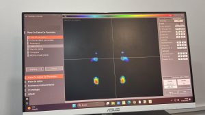 Mapa de presiones plantares y valores de carga obtenidos en la baropodometría