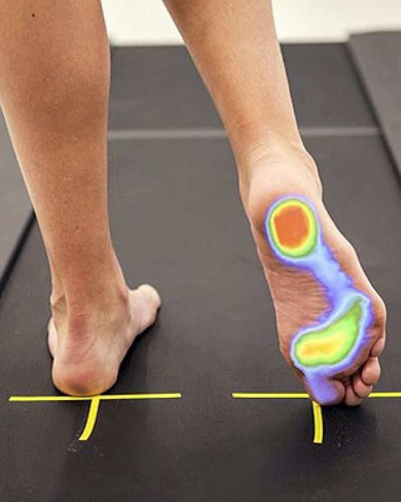 Estudio Biomecánico de la pisada en Barcelona