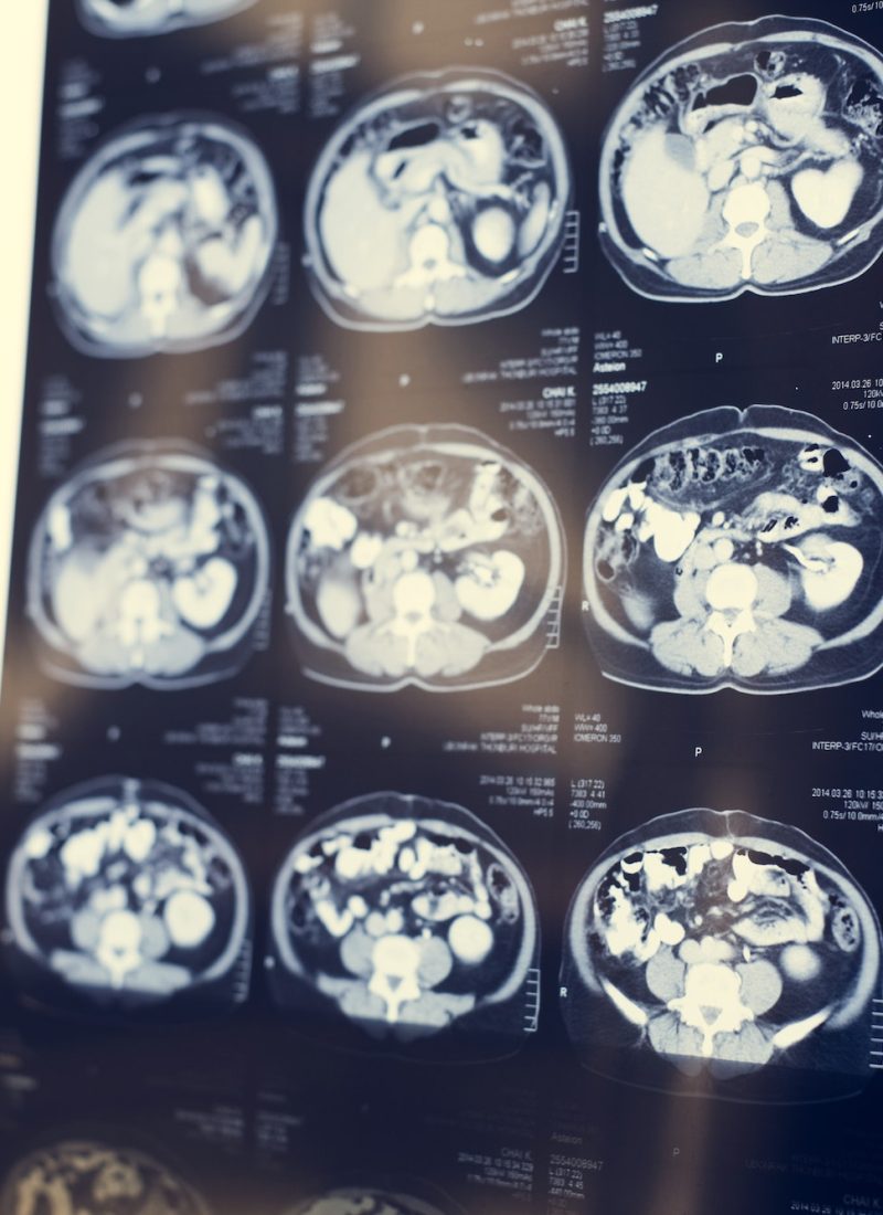 brain-ct-scan-x-ray-film