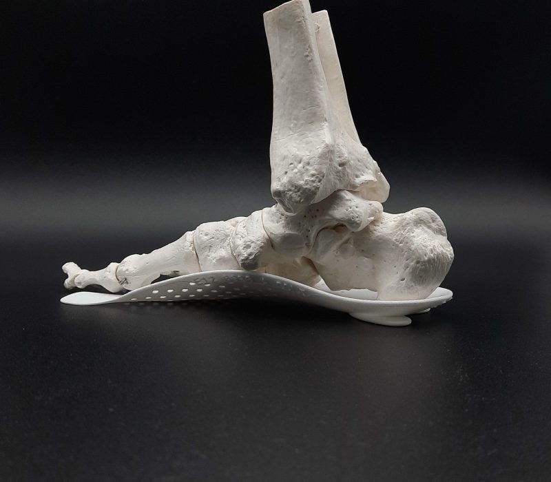 Ortopodología en Barcelona, cuándo usar plantillas ortopédicas