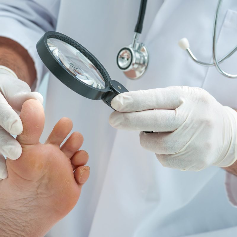 Hallux Limitus, podólogo